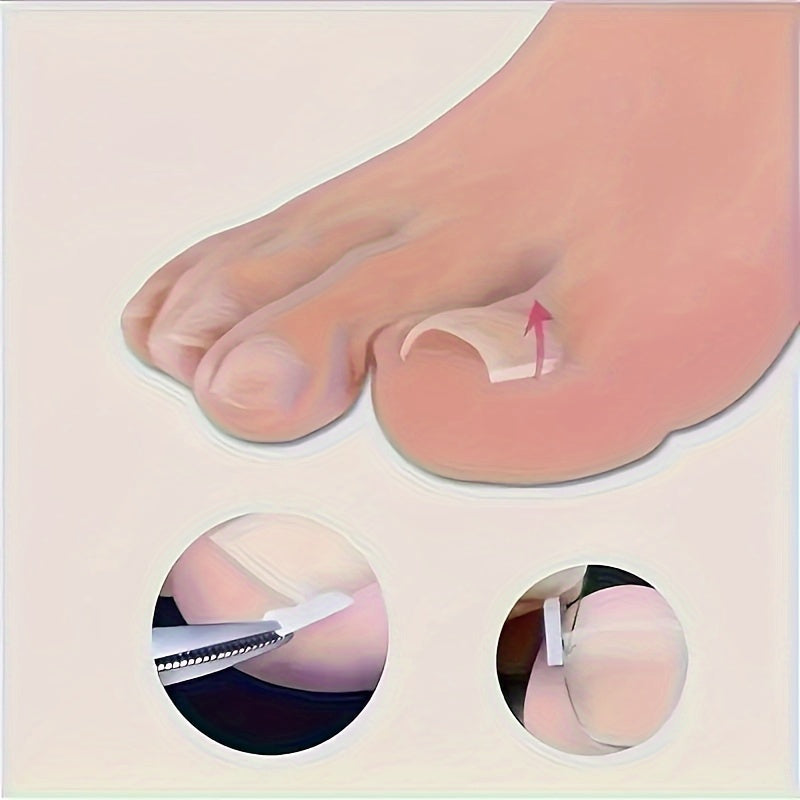 ingrown toenail   20 30   50   70 80 90 100pcs